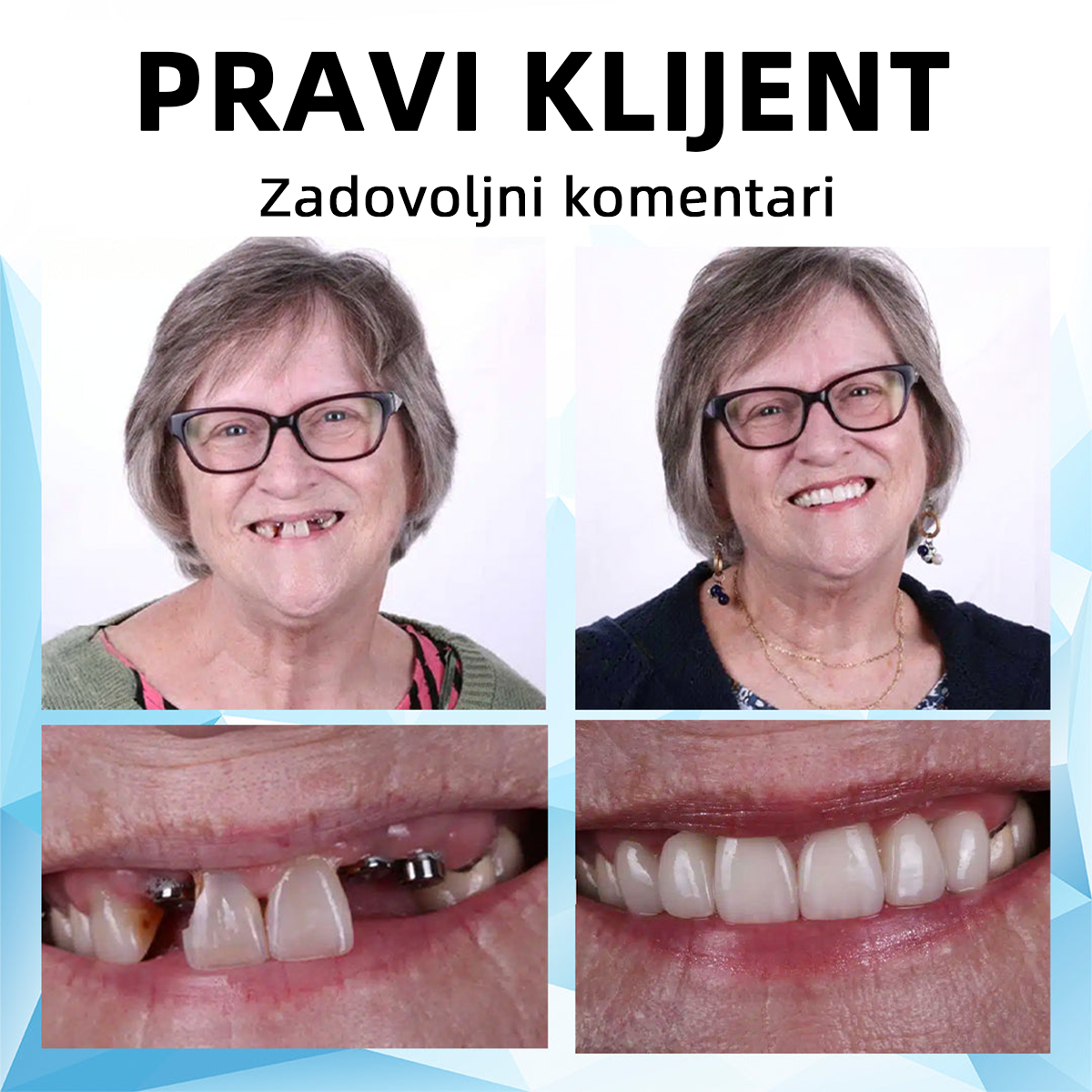 𝐁𝐢𝐤𝐞𝐧𝐝𝐚™ 🦷Set silikonskih proteza (⏰Ograničeni popust, vjenčanje 30 minuta⏰) ✅