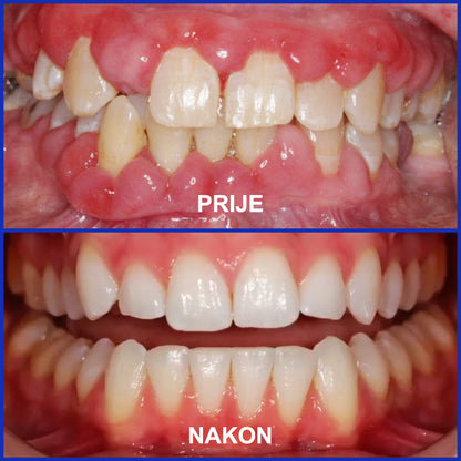 Furzero™ Focussmile tretman s pčelinjim otrovom oralni prah 🦷 (preporučuje CED)🥇